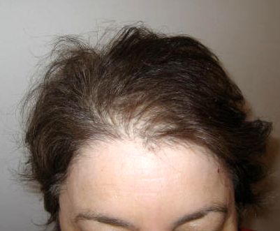 regrow hair after relaxer burn